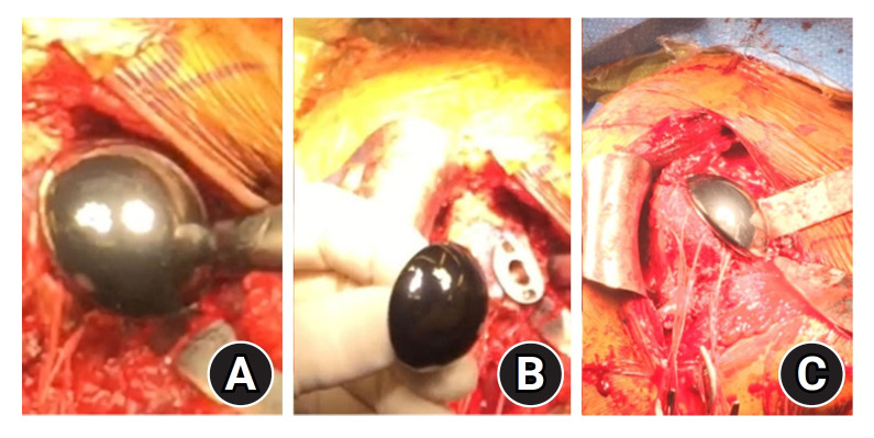 Pyrocarbon hemiarthroplasty and the shoulder: biomechanical and clinical results of an emerging treatment option.
