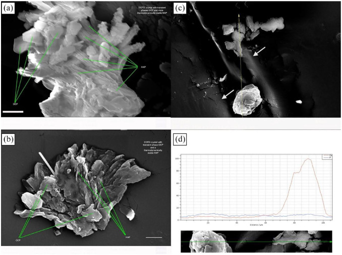 A unique late-onset intraocular lens opacification 23 years after implantation: a clinical and laboratory case report.