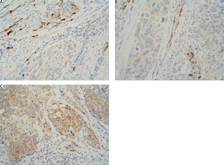 Utility of expression of 4-hydroxynonenal tested by immunohistochemistry for cervical cancer.