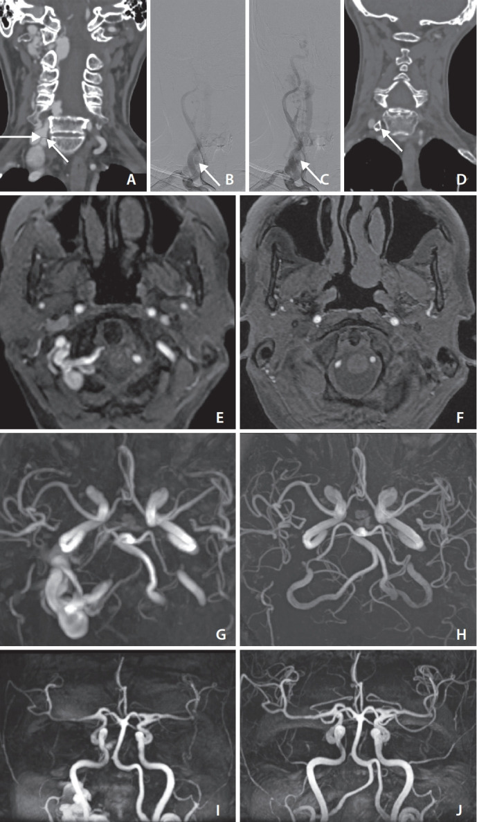 Intrasaccular Flow Disruptor (Woven EndoBridge) Assisted Embolization of Vertebral Arteriovenous Fistulas.