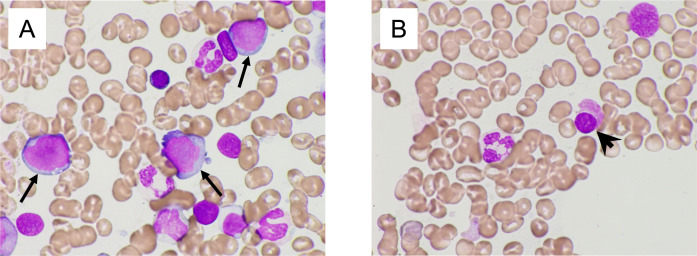 A case of peripheral T-cell lymphoma in which therapy-related myelodysplastic syndrome developed and a second autologous transplantation was performed.