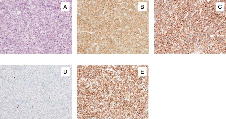 A case of peripheral T-cell lymphoma in which therapy-related myelodysplastic syndrome developed and a second autologous transplantation was performed.