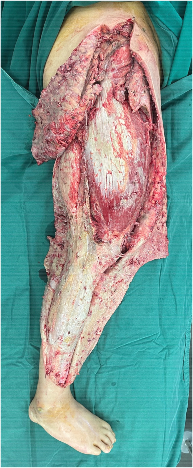 Diagnostic Key Points and Surgical Management of Necrotizing Fasciitis: A Retrospective Study.