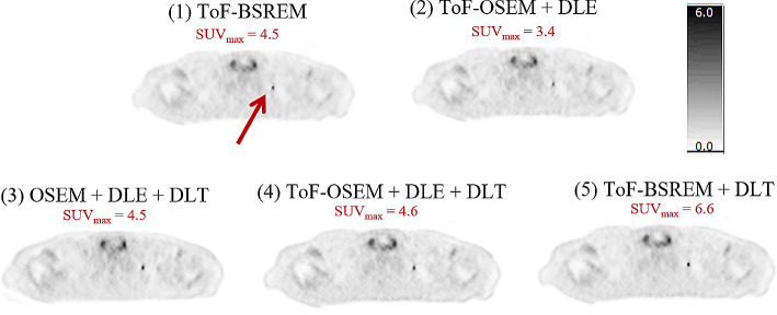Sequential deep learning image enhancement models improve diagnostic confidence, lesion detectability, and image reconstruction time in PET.