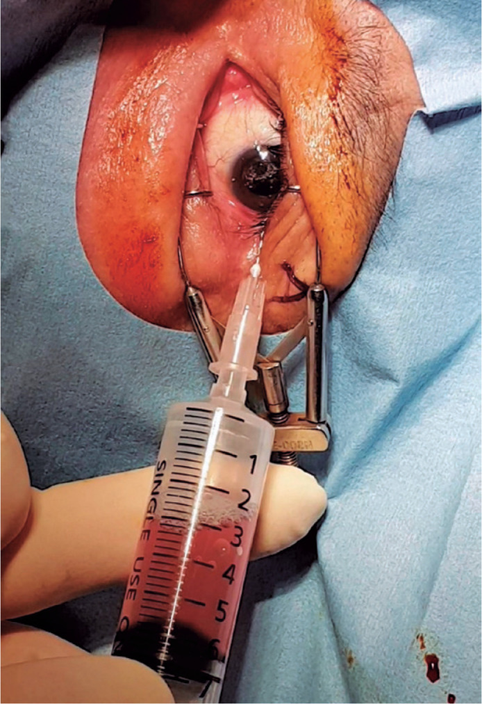 Results of office-based fluid-air exchange for postvitrectomy hemorrhage in diabetic retinopathy.