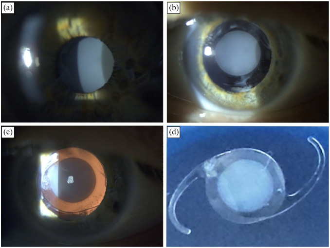 A unique late-onset intraocular lens opacification 23 years after implantation: a clinical and laboratory case report.