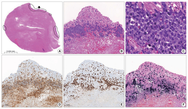 Fibrin-associated large B-cell lymphoma arising in an endovascular graft: first case report in Korea.