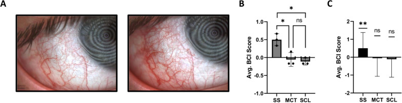 Human tear film protein sampling using soft contact lenses.