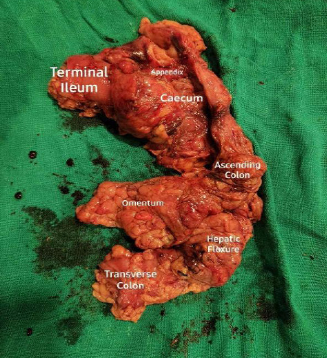 Crohn's Disease Previously Mistreated as Intestinal Tuberculosis Complicated with Ileocecal Lump: A Case Report.