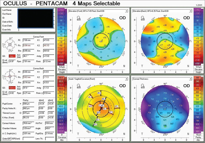 Pre-Descemet's endothelial keratoplasty with glued intraocular lens implantation with pinhole pupilloplasty in a case of ocular comorbidity in achromatopsia.