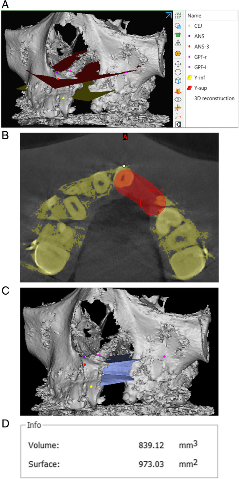 Residual calcified material volume of β-tricalcium phosphate with platelet-rich fibrin in unilateral alveolar bone graft.