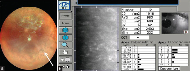 Pre-Descemet's endothelial keratoplasty with glued intraocular lens implantation with pinhole pupilloplasty in a case of ocular comorbidity in achromatopsia.