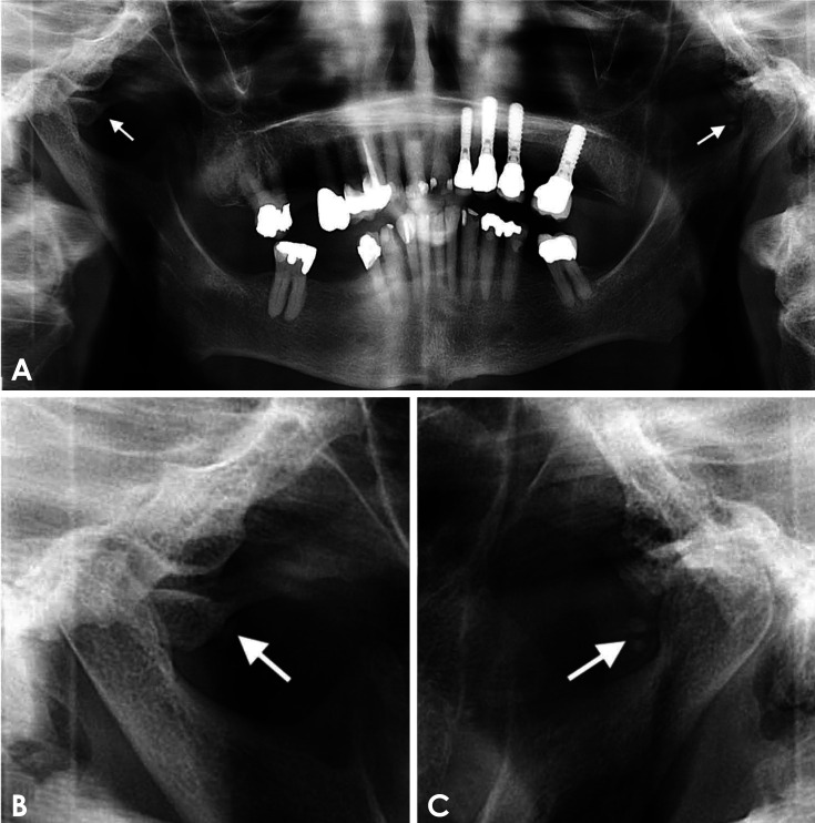 Eustachian tube calcification as an unusual finding on a panoramic radiograph.
