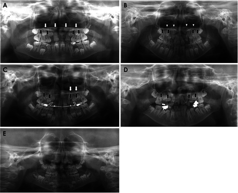 Differences in the panoramic appearance of cleft alveolus patients with or without a cleft palate.