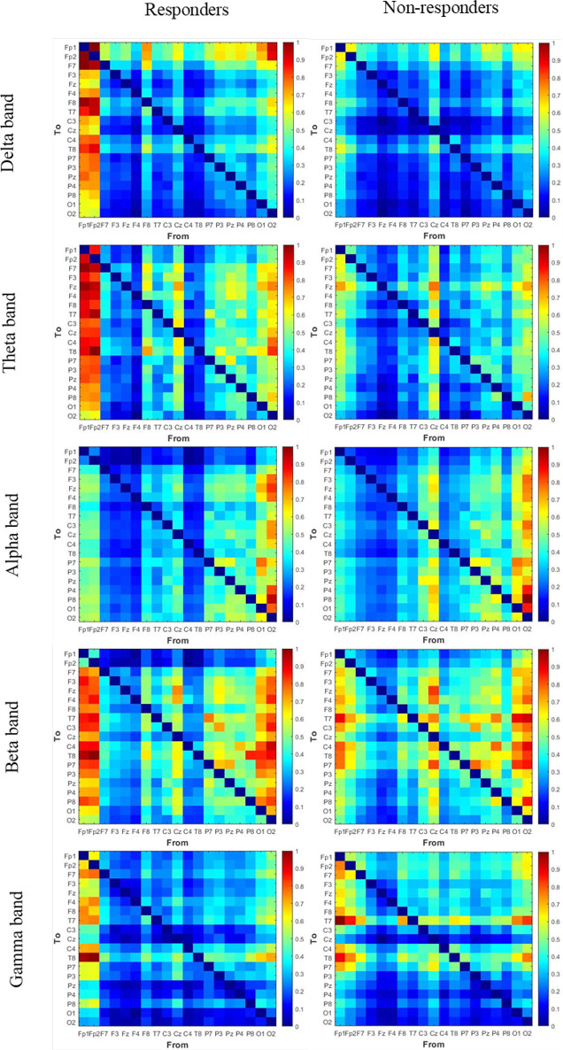 Graph-based Analysis to Predict Repetitive Transcranial Magnetic Stimulation Treatment Response in Patients With Major Depressive Disorder Using EEG Signals.