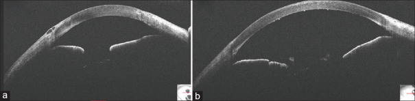 Pre-Descemet's endothelial keratoplasty with glued intraocular lens implantation with pinhole pupilloplasty in a case of ocular comorbidity in achromatopsia.