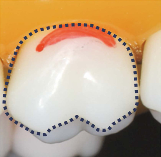 Utility of intraoral scanner imaging for dental plaque detection.