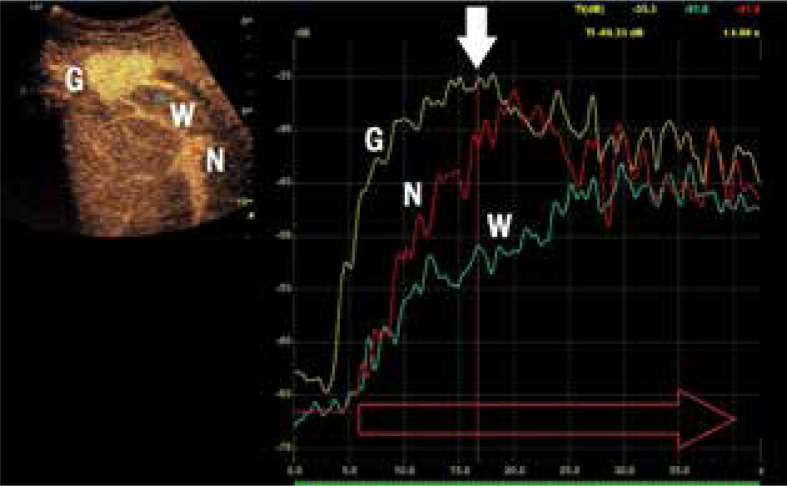 Contrast-enhanced ultrasonography as a method of monitoring focal liver lesions - initial report.