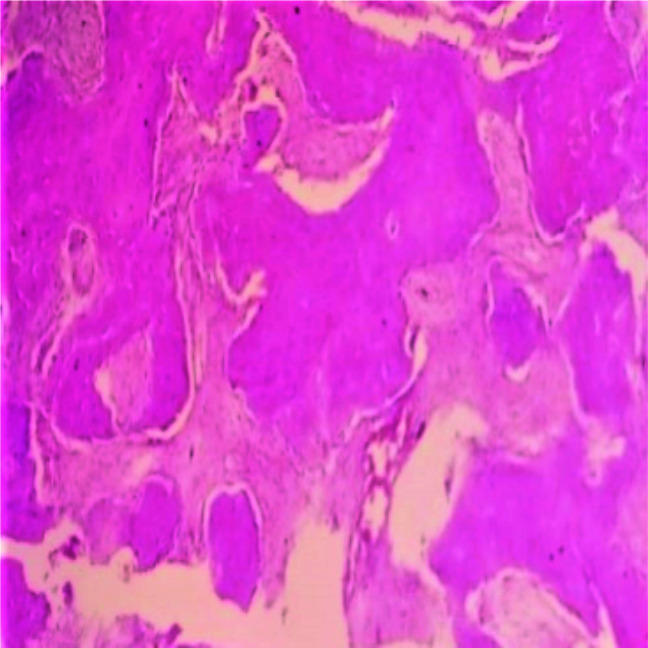 Jaw Fibro-Osseous Lesions: Use of a Predictive Index in Grading Probable Malignant Changes and a Review of Cases.