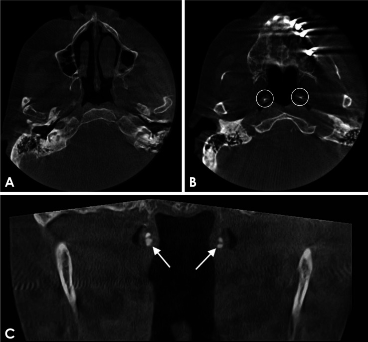 Eustachian tube calcification as an unusual finding on a panoramic radiograph.