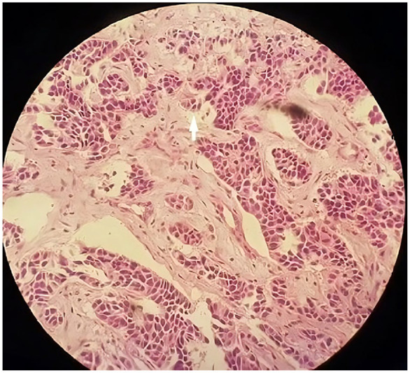 The Relationship Between Tumor Budding and Patient's Survival in Breast Cancer.