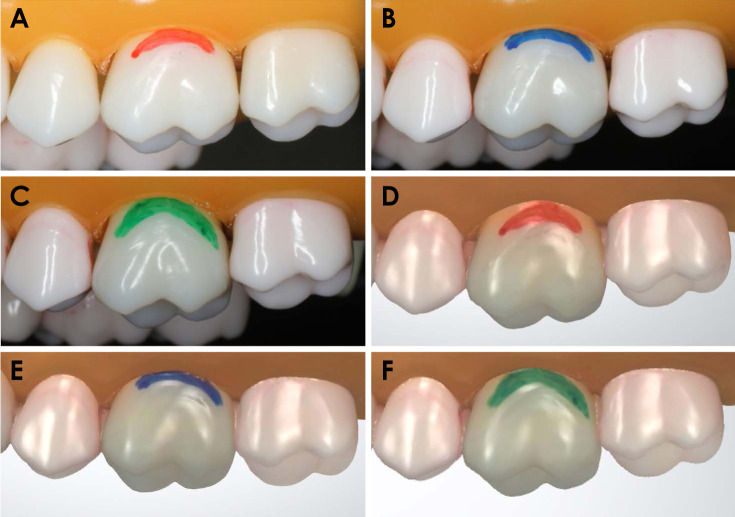Utility of intraoral scanner imaging for dental plaque detection.