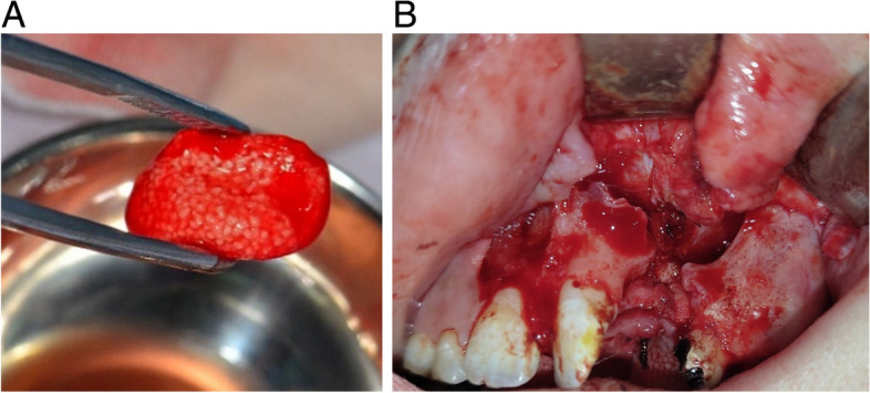 Residual calcified material volume of β-tricalcium phosphate with platelet-rich fibrin in unilateral alveolar bone graft.