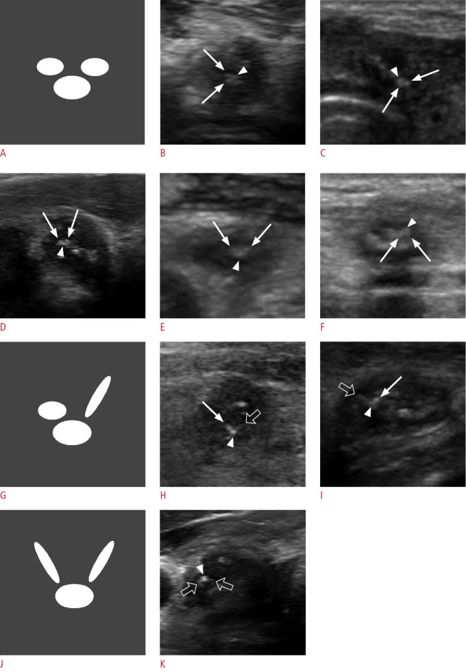 Knot-and-ear sign: a pathognomonic ultrasonographic feature of suture granuloma after thyroid surgery.