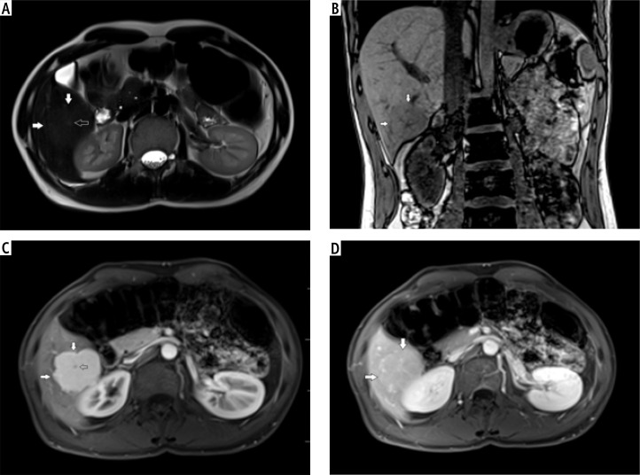 Contrast-enhanced ultrasonography as a method of monitoring focal liver lesions - initial report.