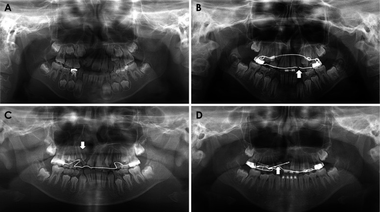 Differences in the panoramic appearance of cleft alveolus patients with or without a cleft palate.