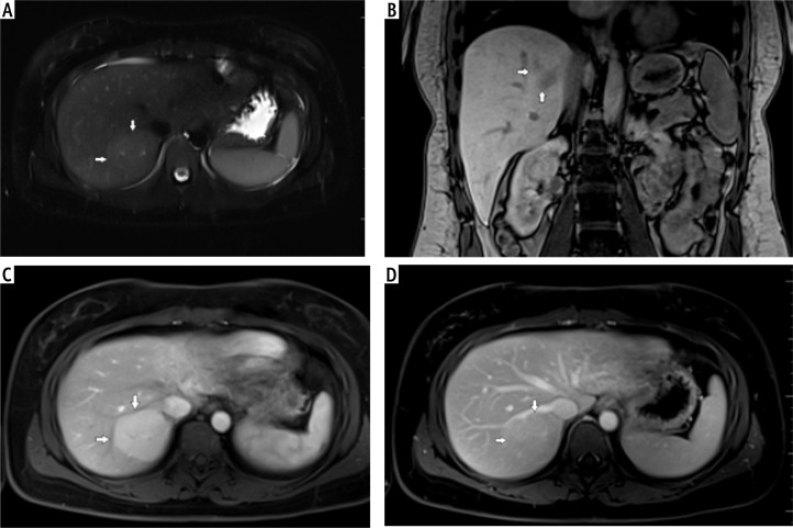 Contrast-enhanced ultrasonography as a method of monitoring focal liver lesions - initial report.