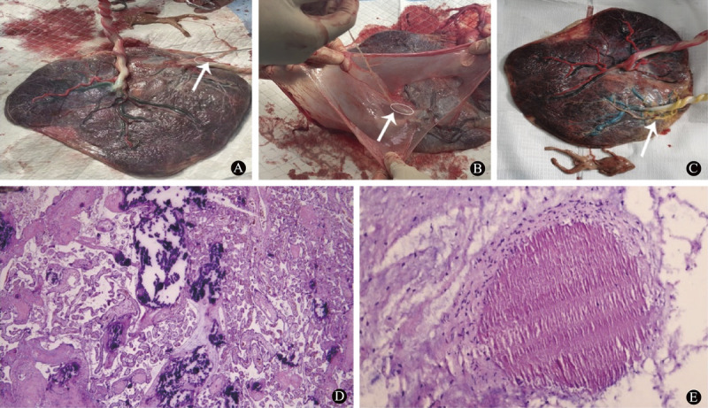 Intrauterine Treatment of Monochorionic Triamniotic Triplet Pregnancy with Twin Reverse Arterial Perfusion Sequence.