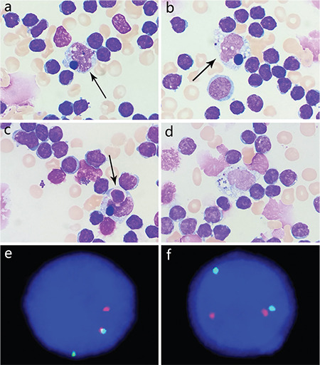 Circulating Monocytes Phagocytosing Lymphocytes in the Small-Cell Variant of T-Cell Prolymphocytic Leukemia