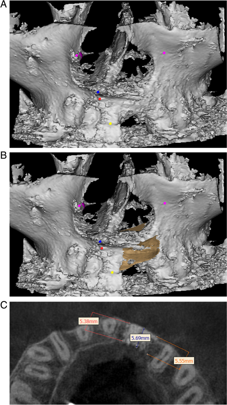 Residual calcified material volume of β-tricalcium phosphate with platelet-rich fibrin in unilateral alveolar bone graft.