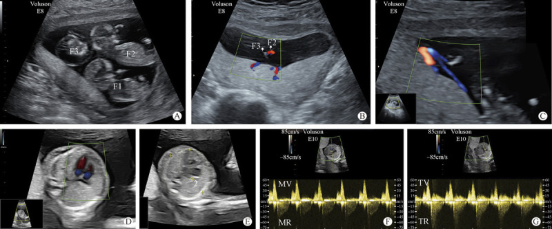 Intrauterine Treatment of Monochorionic Triamniotic Triplet Pregnancy with Twin Reverse Arterial Perfusion Sequence.