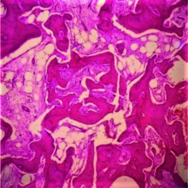 Jaw Fibro-Osseous Lesions: Use of a Predictive Index in Grading Probable Malignant Changes and a Review of Cases.