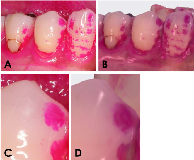 Utility of intraoral scanner imaging for dental plaque detection.