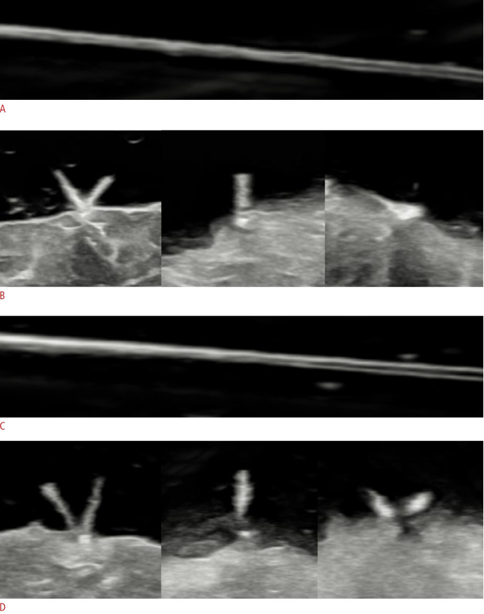 Knot-and-ear sign: a pathognomonic ultrasonographic feature of suture granuloma after thyroid surgery.