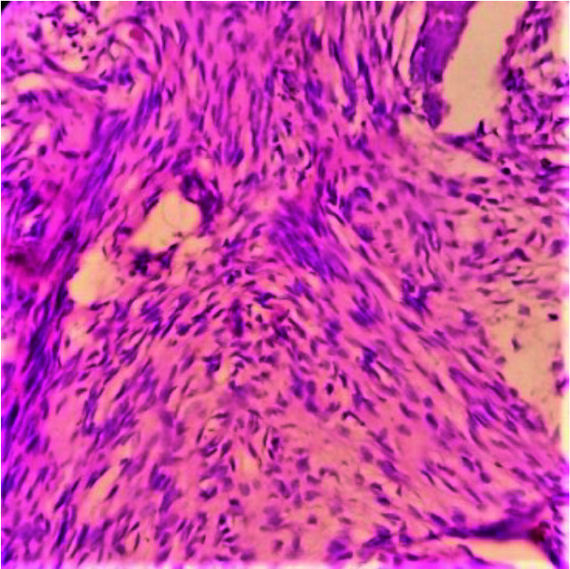 Jaw Fibro-Osseous Lesions: Use of a Predictive Index in Grading Probable Malignant Changes and a Review of Cases.