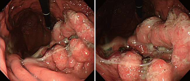 Gastric Cancer Showing Rapid Recurrence and Progression: A Case of Gastric Adenocarcinoma With Enteroblastic Differentiation.