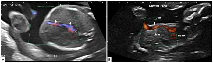 Absence of Ductus Venosus: A Comparison of 2 Distinctive Fetal Autopsy Cases and Embryologic Perspectives.
