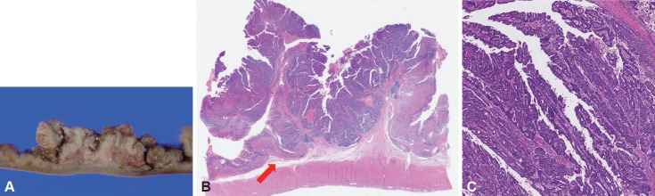 Gastric Cancer Showing Rapid Recurrence and Progression: A Case of Gastric Adenocarcinoma With Enteroblastic Differentiation.