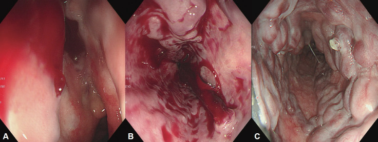 [Endoscopic Treatment and Prevention of Acute Variceal Hemorrhage].