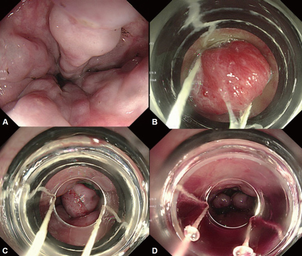 [Endoscopic Treatment and Prevention of Acute Variceal Hemorrhage].