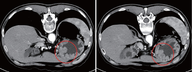 Gastric Cancer Showing Rapid Recurrence and Progression: A Case of Gastric Adenocarcinoma With Enteroblastic Differentiation.