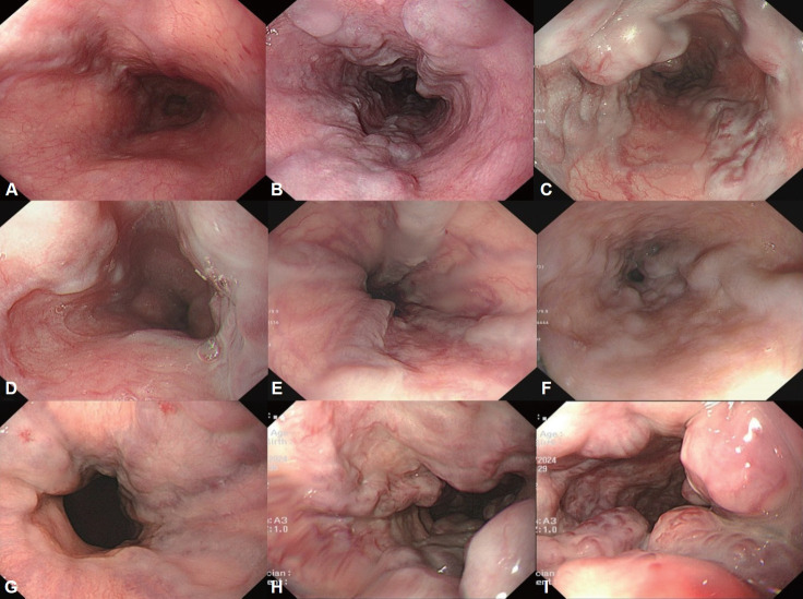 [Endoscopic Treatment and Prevention of Acute Variceal Hemorrhage].