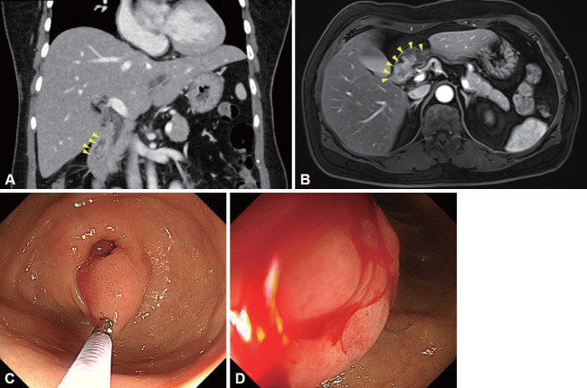 Duodenal Mass Detected on the Screening Endoscopy.