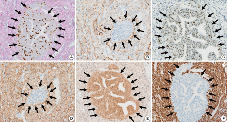 Malignant potential of neuroendocrine microtumor of the pancreas harboring high-grade transformation: lesson learned from a patient with von Hippel-Lindau syndrome.