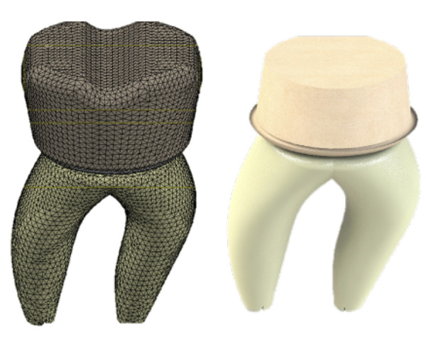 [Compressive stress in three types of finishing lines with lithium disilicate crowns in permanent teeth: finite element analysis].
