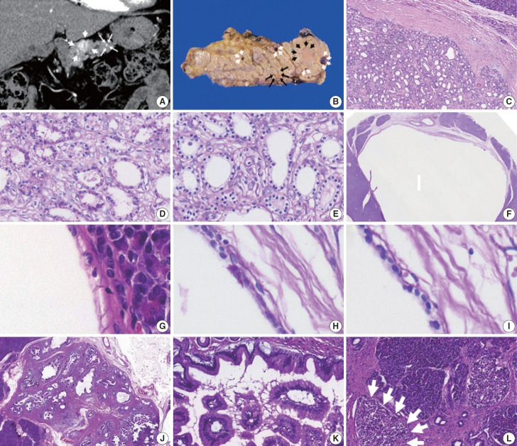 Malignant potential of neuroendocrine microtumor of the pancreas harboring high-grade transformation: lesson learned from a patient with von Hippel-Lindau syndrome.